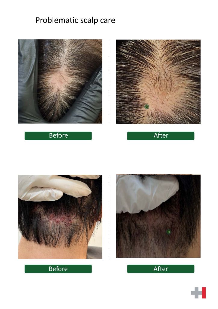 두피 모발 Before After 사례 1