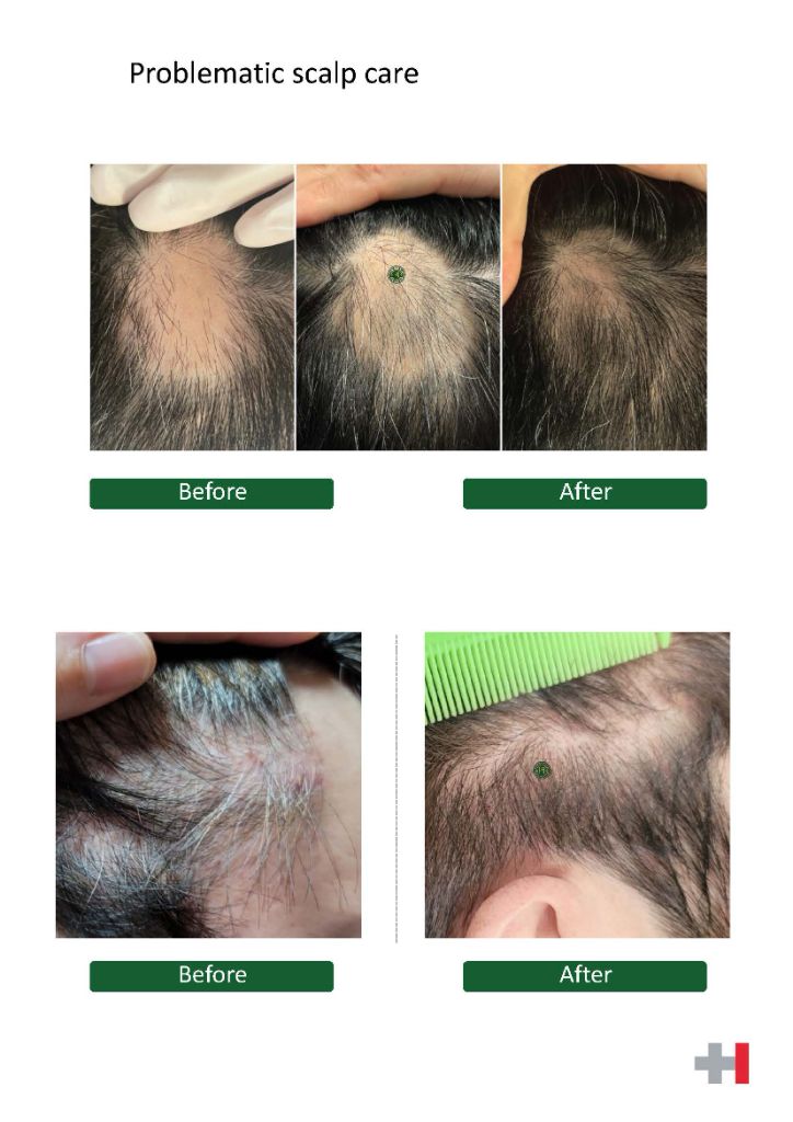 두피 모발 Before After 사례 2